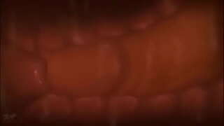 ���ორწილი საშვილოსნოს